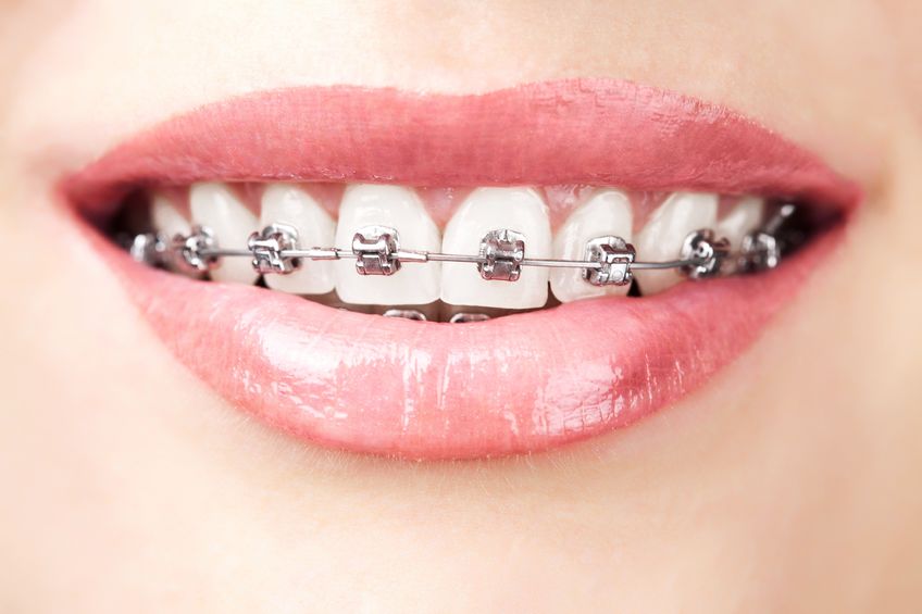 Braces and Oral health